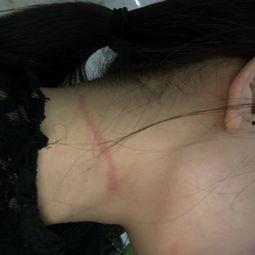 吃瓜之后脖子痒,揭秘脖子痒的神秘源头